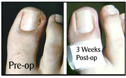 ingrowing toenail removal Northampton podiatrist